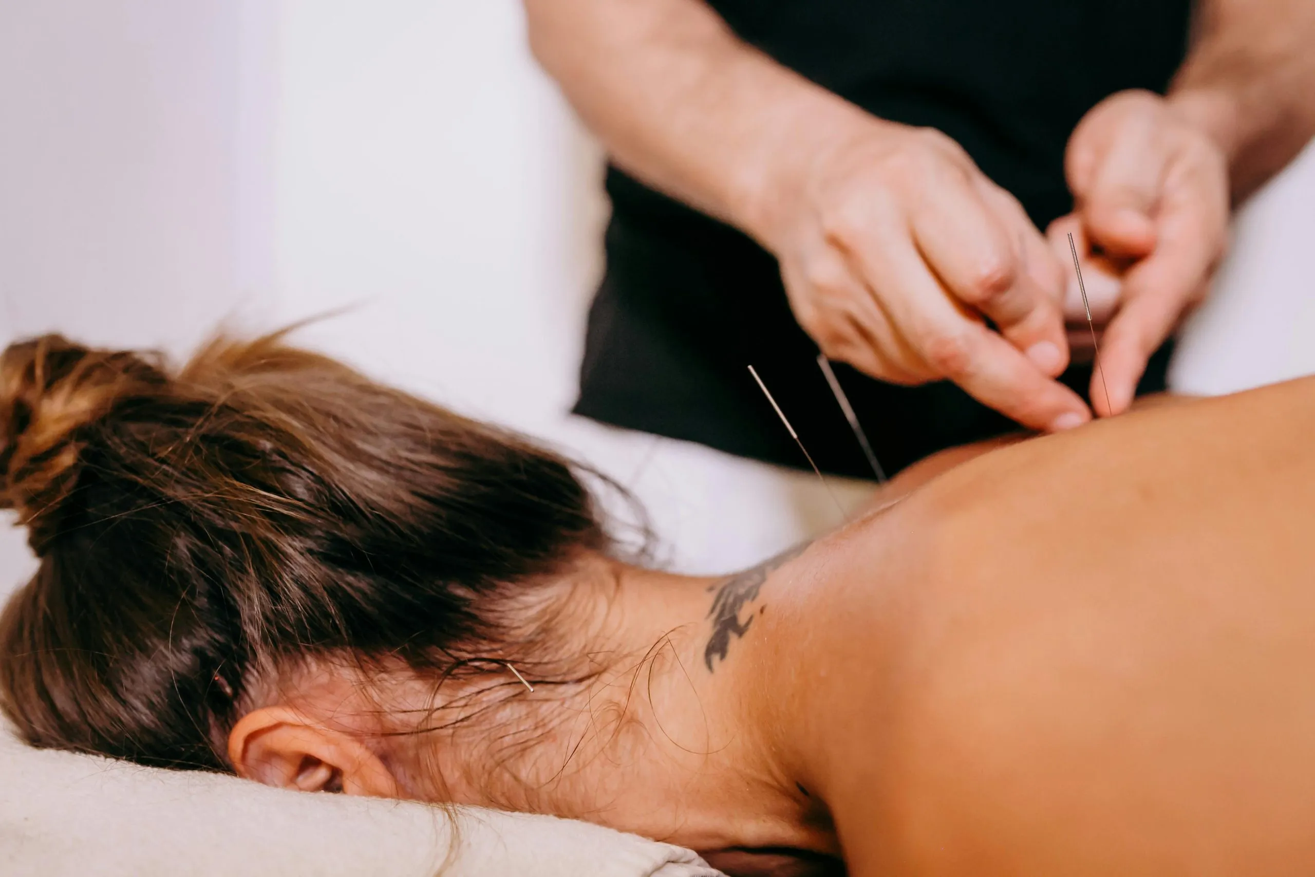 Acupuncture treatment by a Registered Acupuncturist (R.Ac) at 4Seasons in downtown Toronto