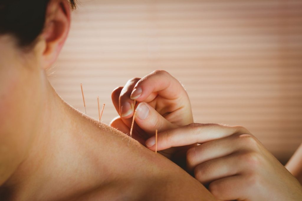 Tech Neck and Acupuncture: Why Your Cervical Spine Is the Root of Your Headaches