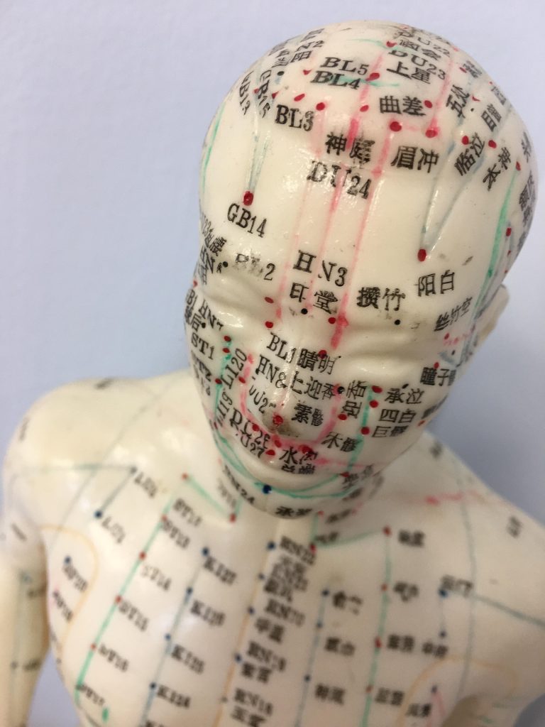 Acupuncture for IBS and Bloating: What the Research Shows.
